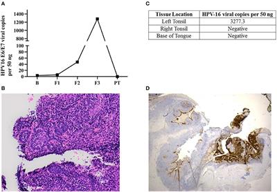 An Occult HPV-Driven Oropharyngeal Squamous Cell Carcinoma Discovered Through a Saliva Test